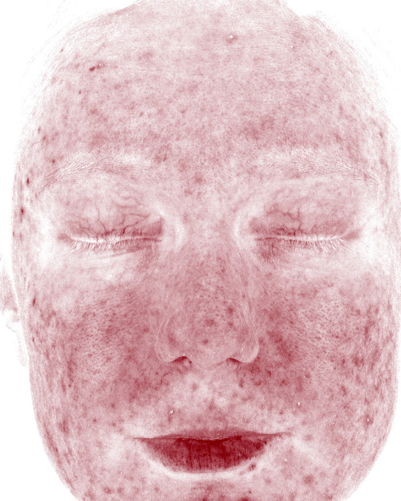Skin Redness (RBX View) — After
