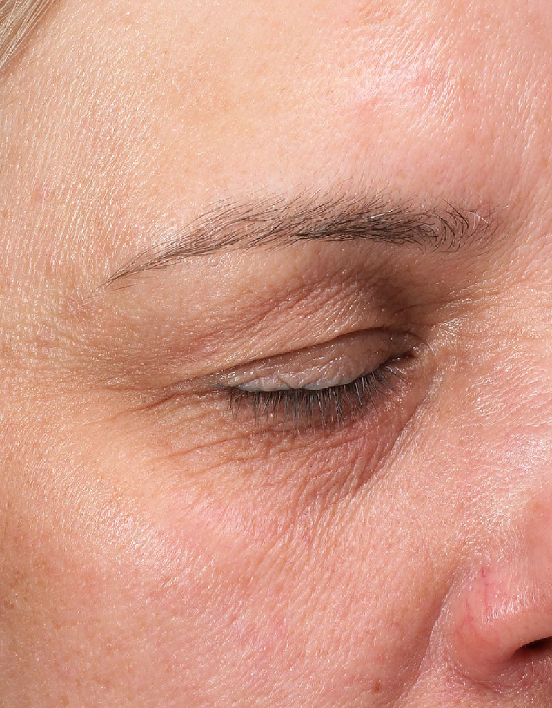Fine Lines & Wrinkles — Before