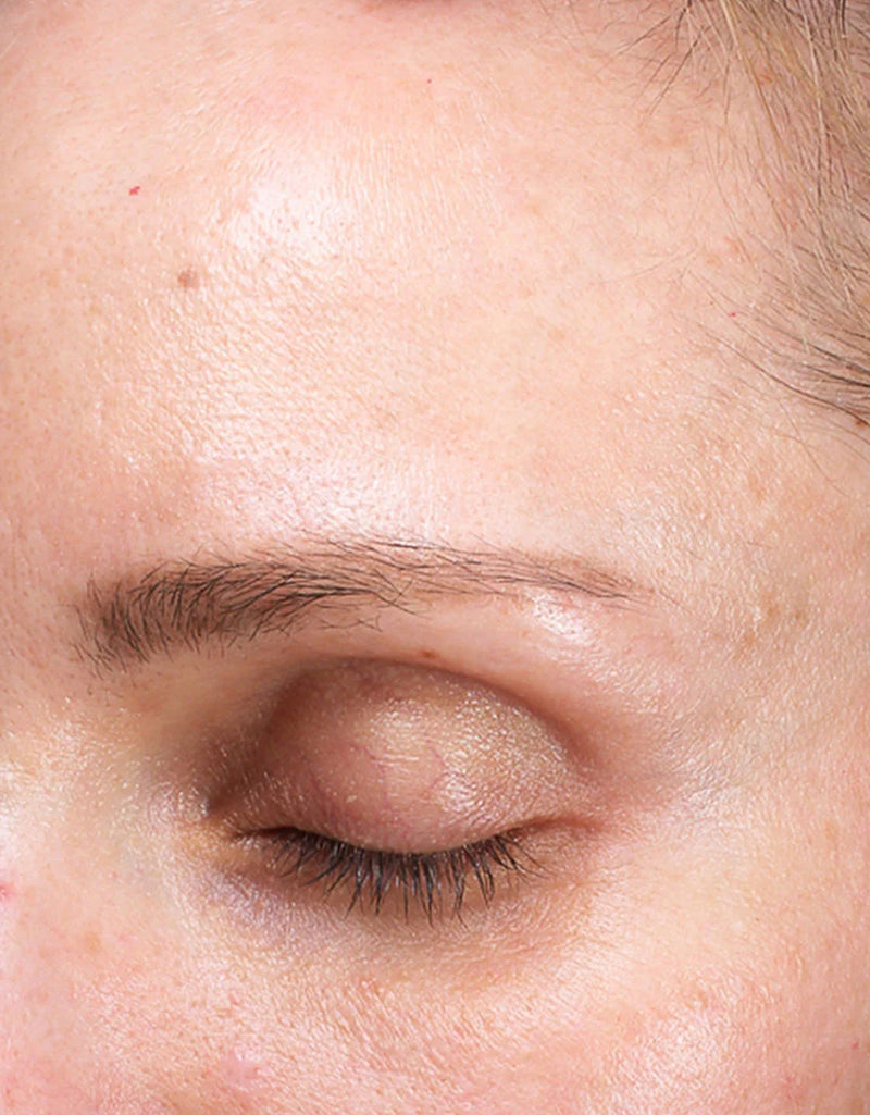 Fine Lines & Wrinkles — After