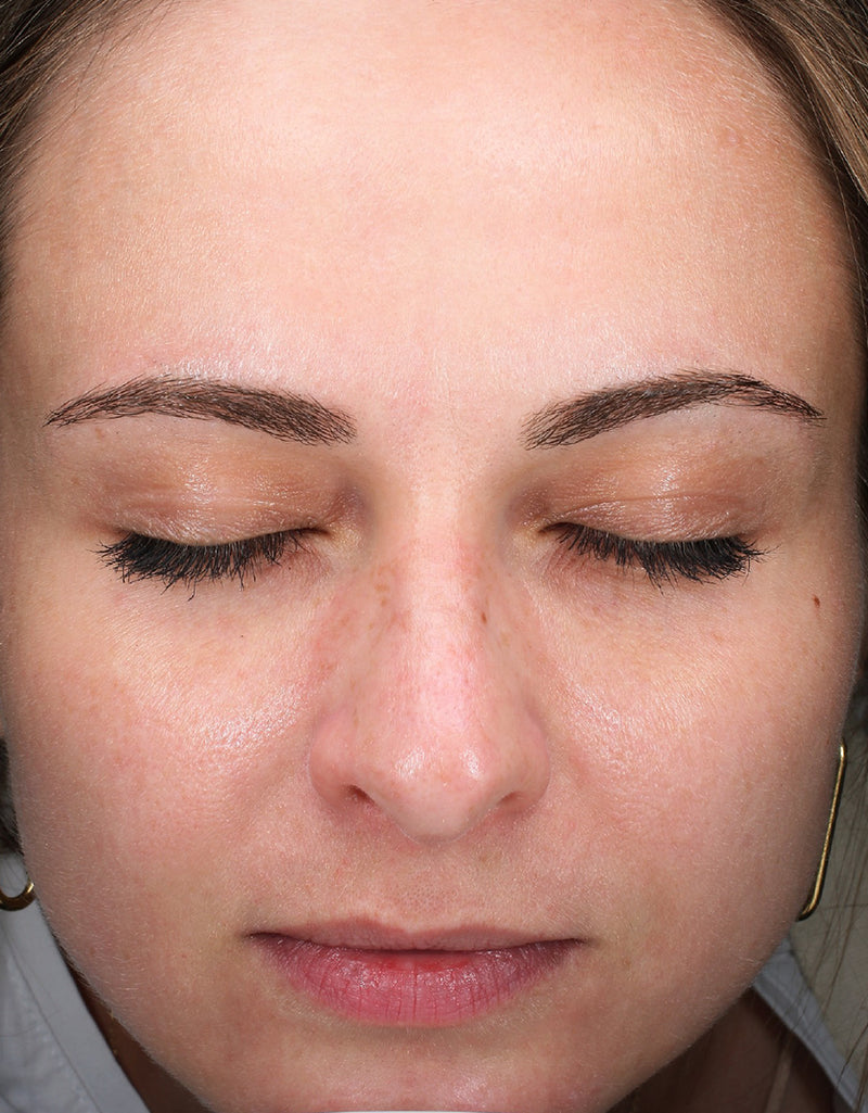 Skin Redness — After