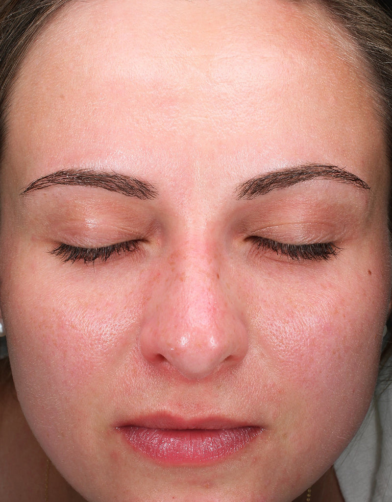 Skin Redness — Before