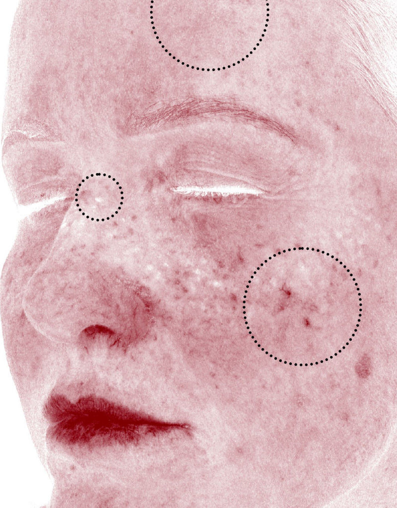 Skin Redness (RBX View) — After