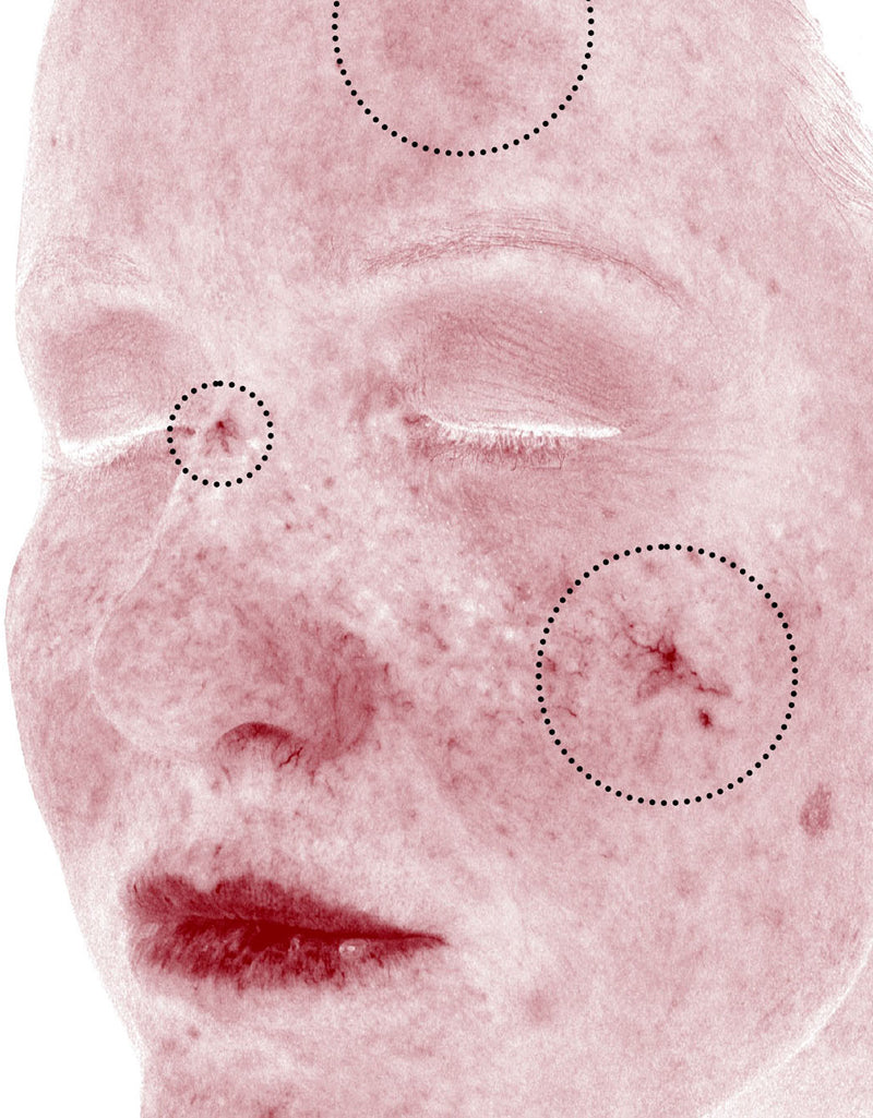 Skin Redness (RBX View) — Before