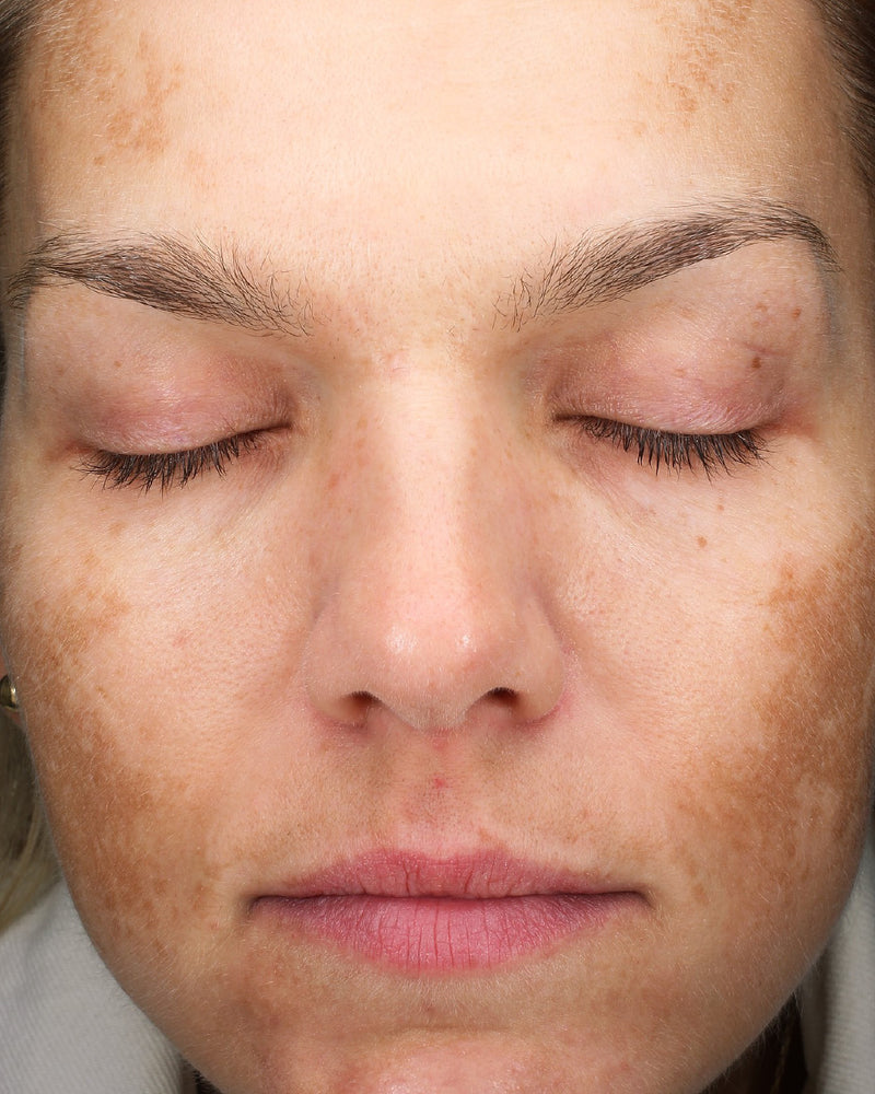 Dark Spots — After