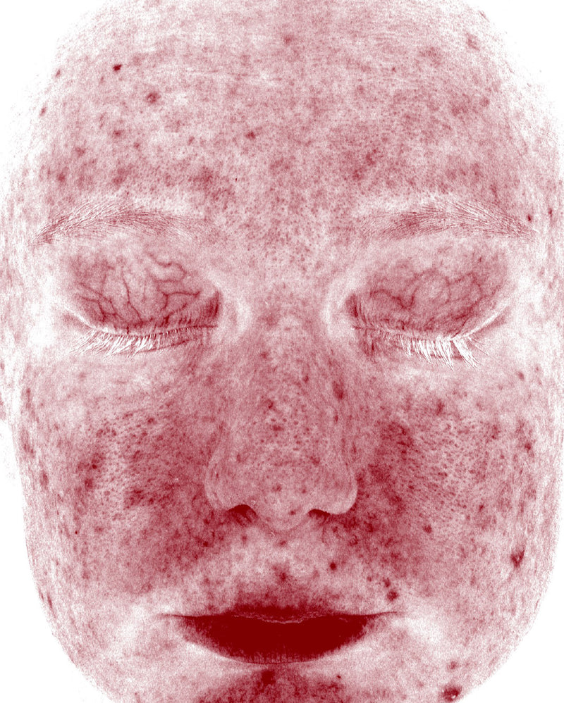 Skin Redness (RBX View) — Before