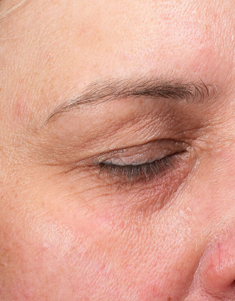 Fine Lines & Wrinkles — After