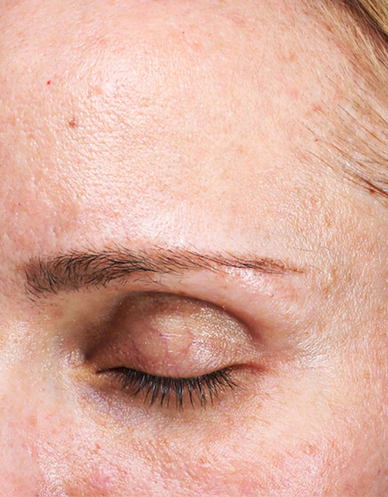 Fine Lines & Wrinkles — Before