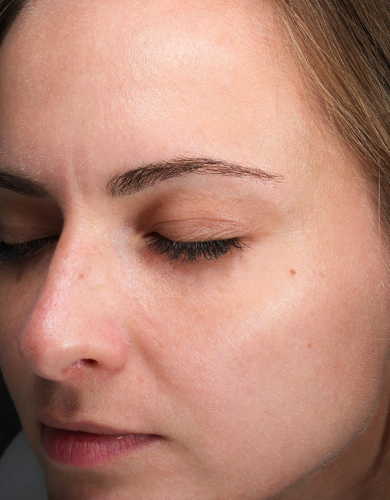 Redness & Irritation — After