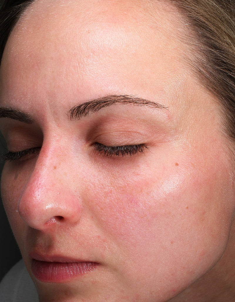 Redness & Irritation — Before