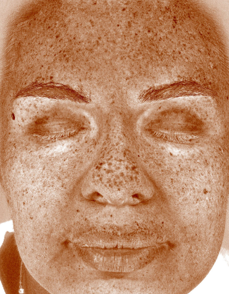 Dark Spots & Hyperpigmentation — After