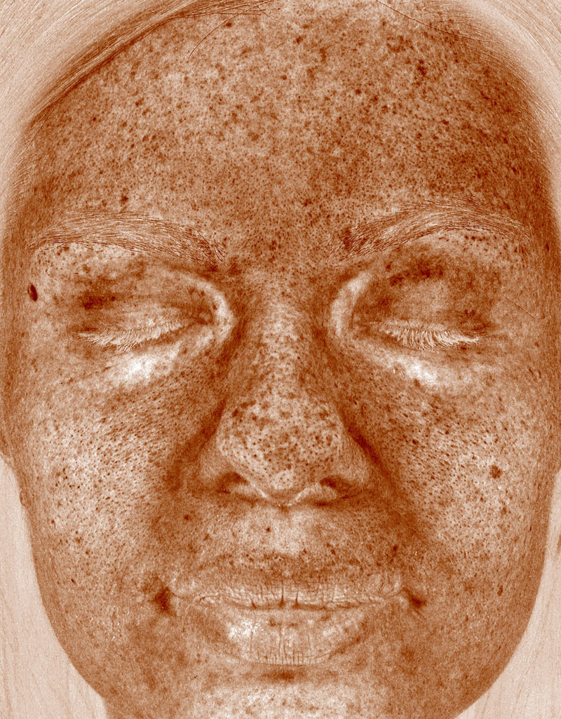 Dark Spots & Hyperpigmentation — Before