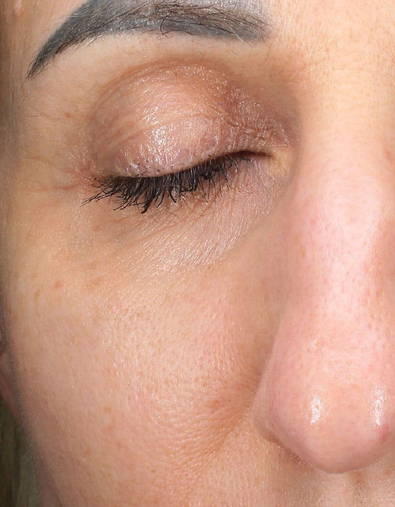 Fine Lines & Wrinkles — After