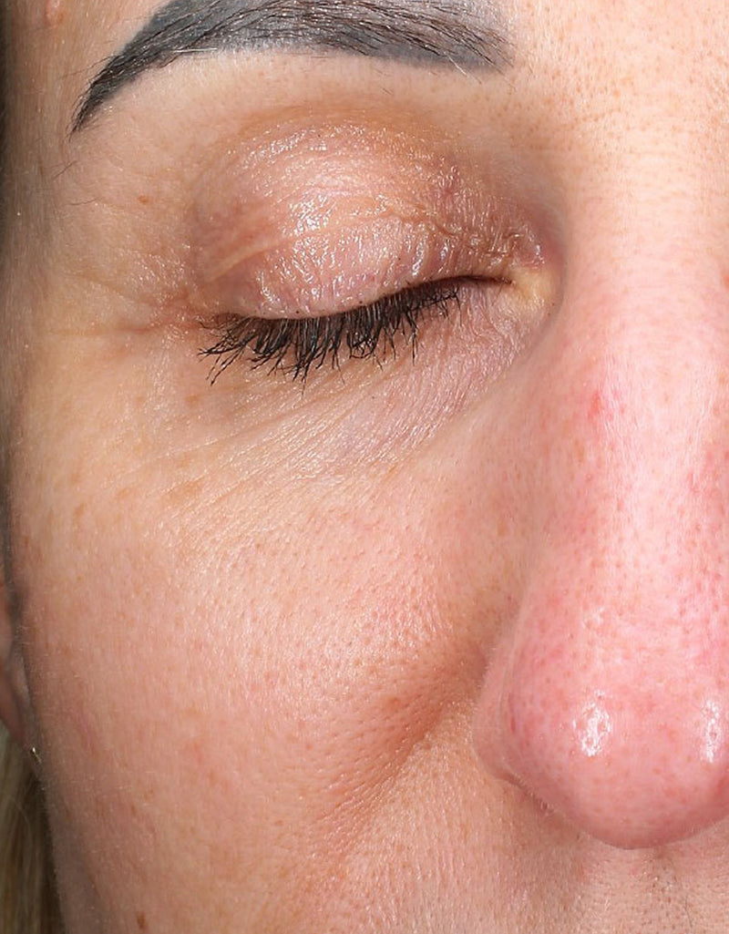 Fine Lines & Wrinkles — Before