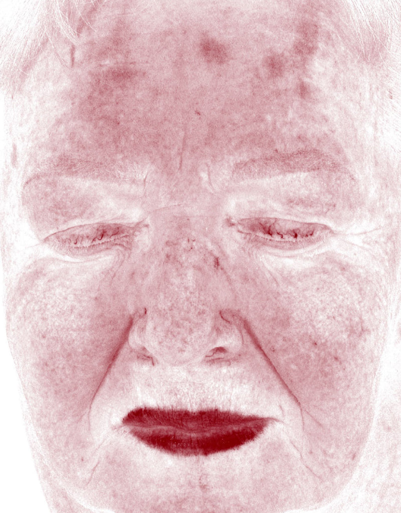 Skin Redness (RBX View) — After
