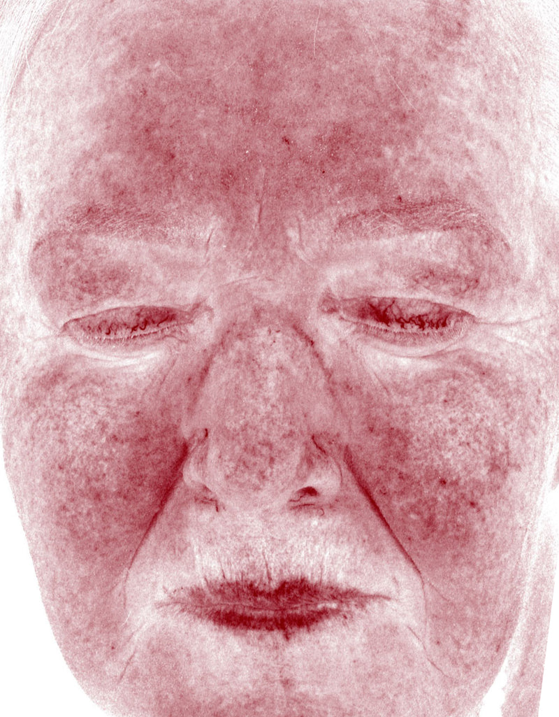 Skin Redness (RBX View) — Before